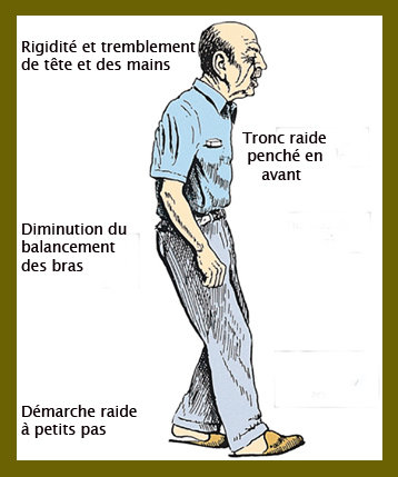 Parkinsonnien-posture.jpg