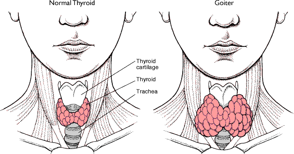 goiter.gif