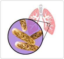 tuberculose_pm-1.gif